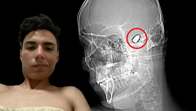 Kafasındaki Patlayıcı ile Gezen Genç: Gerçekten Yaşanan Bir Kâbus